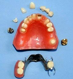 dental bridge model impllant crown combination restoration 