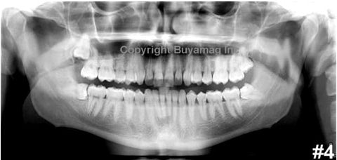 Dental Panoramic X-Ray Images Photos