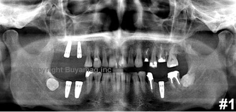 Dental Panoramic X-Ray Reading Images