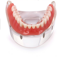 dental 4 Implants Locator Overdenture Model