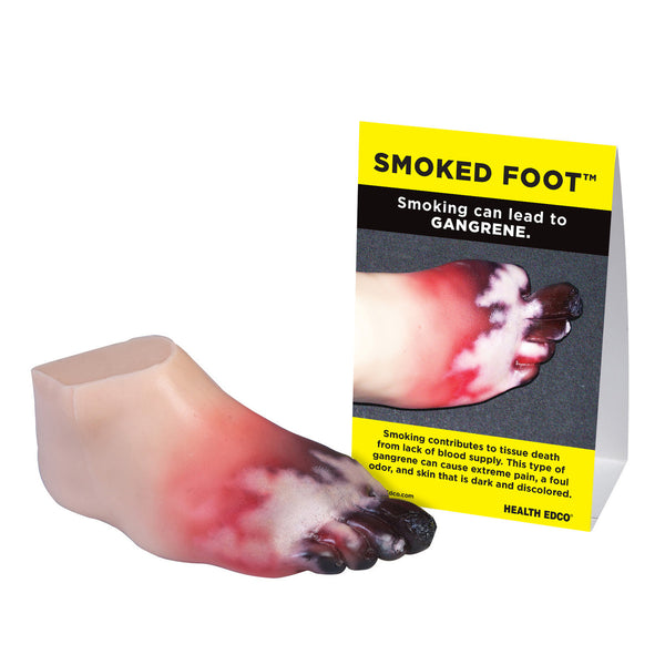Gangrene Foot Model Consequences Of Smoking Tobacco