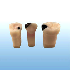 pedo child pulpotomy caries endodontic teeth 