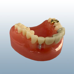dental implant bridge inlay model