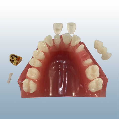 dental crown bridge inlay model