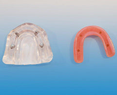 Dental Maxillary Implant Model 4 Implants Simulated Screws Over-denture