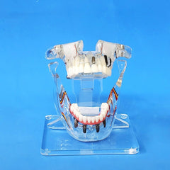 dental restoration sinuses lift  implant model