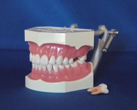 Dental Model 28  With Removable Teeth