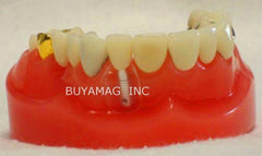 Dental Implants Crown & Bridge Prtial Combination 9 parts Model