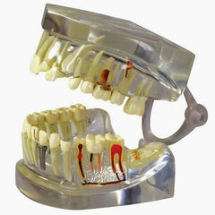 dental model with disease