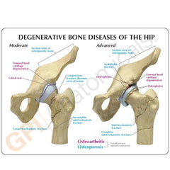 Hip Joint 4 Stage Degenerative Bone Disease Models