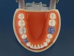 Dental Hygiene Periodontal Assisting Model calibration caries detection