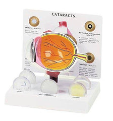 Cataract Eye Model With 6 lenses