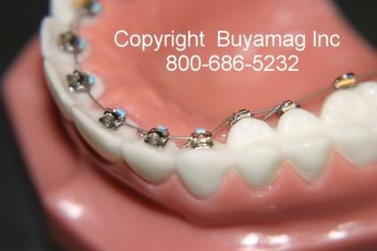 Lingual Orthodontic Model With STB Mini Lingual Brackets