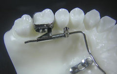 Temporary Anchorage Devices TAD Orthodontic Model #1