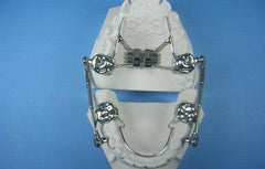 Telescoping Herbst Orthodontic Model