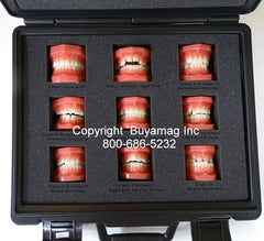 Orthodontic models Malocclusion
