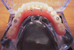Over-Denture Implant Model