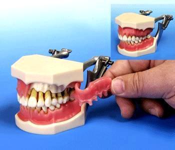 Dental Periodontal Disease & Caries Model - 5 Tooth Resin Demonstration Model For Teaching & Student Learning