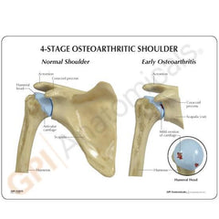 Shoulder Joint4 Stage Osteoarthritic Degeneration