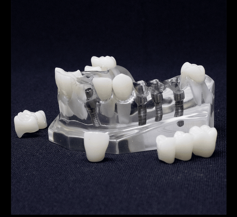 Dental Implants Crown Bridges model