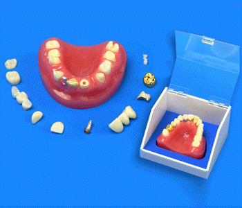 dental teeth restoration implant model