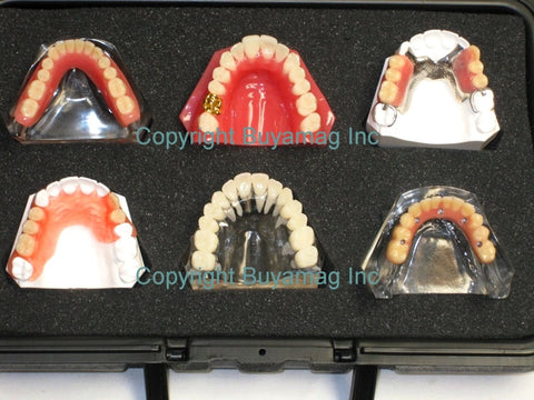 Dental Restoration Patient Education