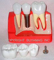 Dental Implant Models Operative
