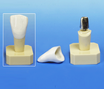 Dental Post Core Model