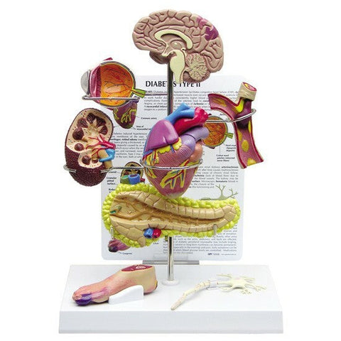 Diabetes Model Set Display Disease Effected Organs