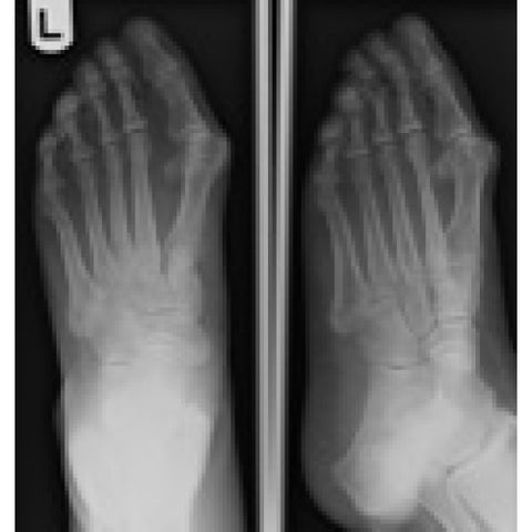 Foot Ankle Fibula X-Ray Images  