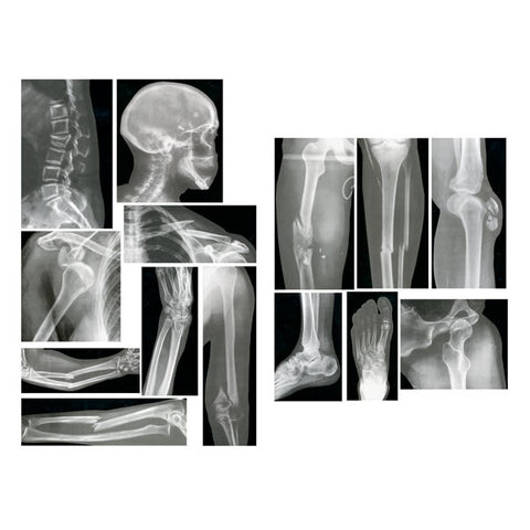 Human Broken Bones X-Ray Images 