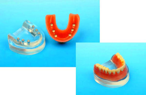 Dental Implants Cosmetic Operative Models