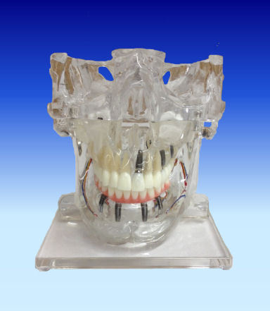 Implants With Sinuses Model 