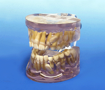 Impacted Cuspid Model