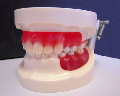 Ortho Wax Form Models