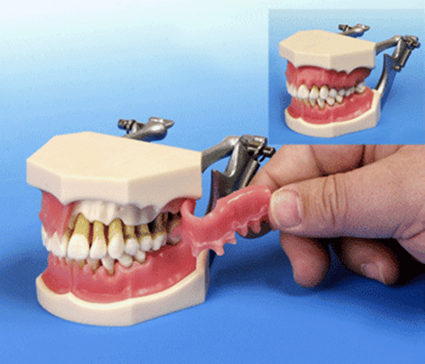periodontal hygiene disease model