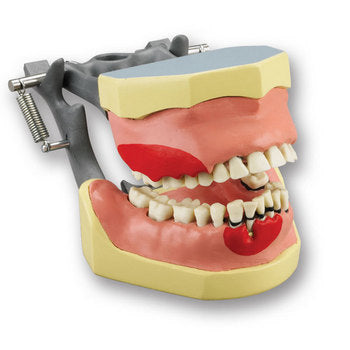 Tooth Extraction Root Planning Surgery   