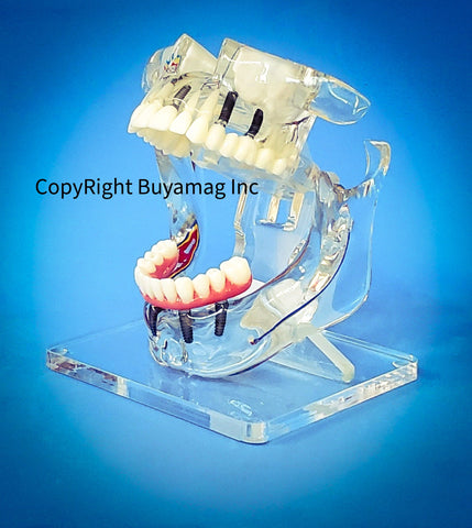 Dental Crown Bridge Restoration Cosmetic Model