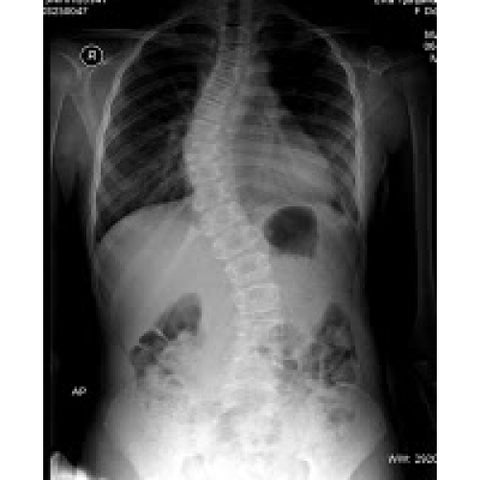 Spine X-Ray Images