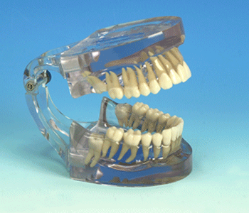 4 Teeth Impactions Model