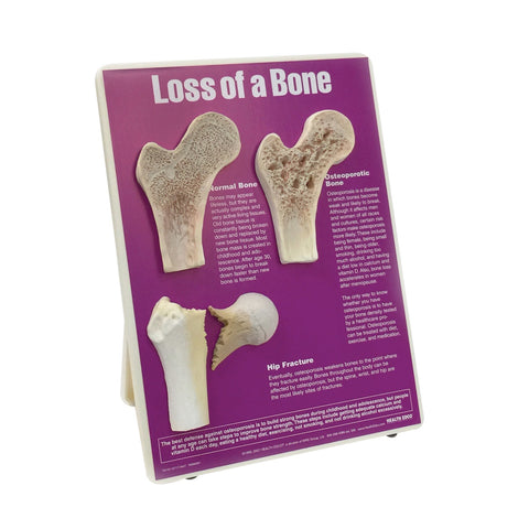 loss of bone hip osteoporosis display model
