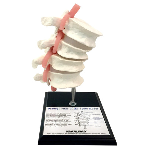Osteoporosis-of-the-Spine-Model