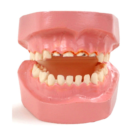 Baby Bottle Tooth Pathology Decay model