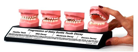 baby tooth decay pathology model