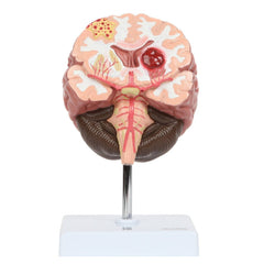 brain model with pathology