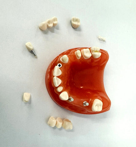 dental cosmetic restoration model bridge crown onlay inlay 
