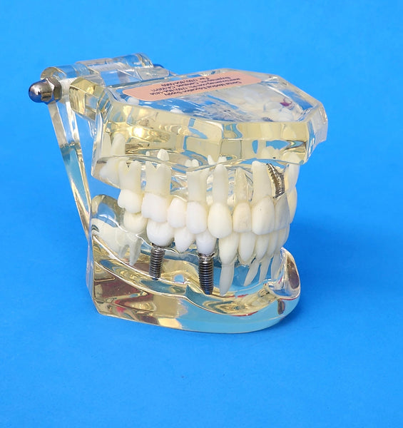 dental cosmetic restoration bridges model