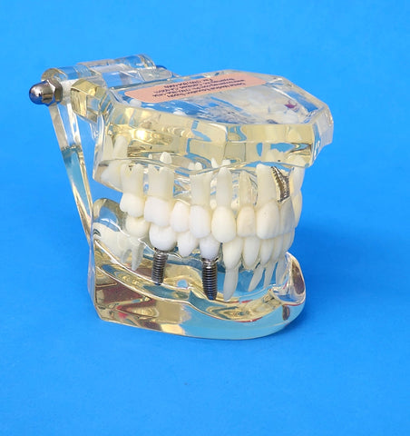 dental cosmetic restoration bridges model