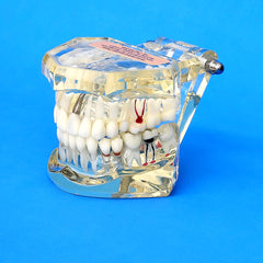 dental restoration implant model