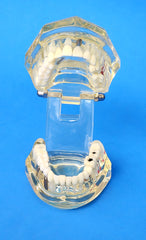 dental implants crown bridge model
